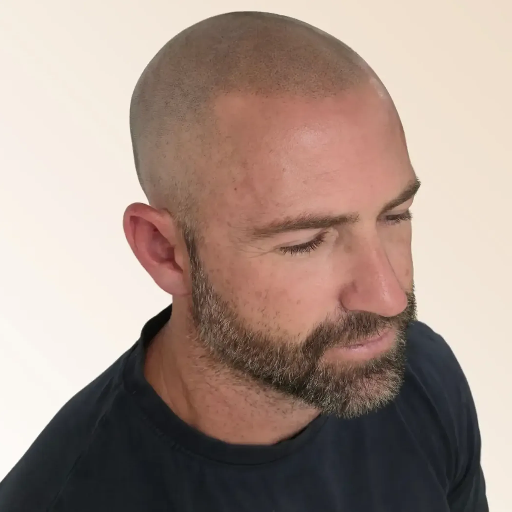 scalp micropigmentation treatment