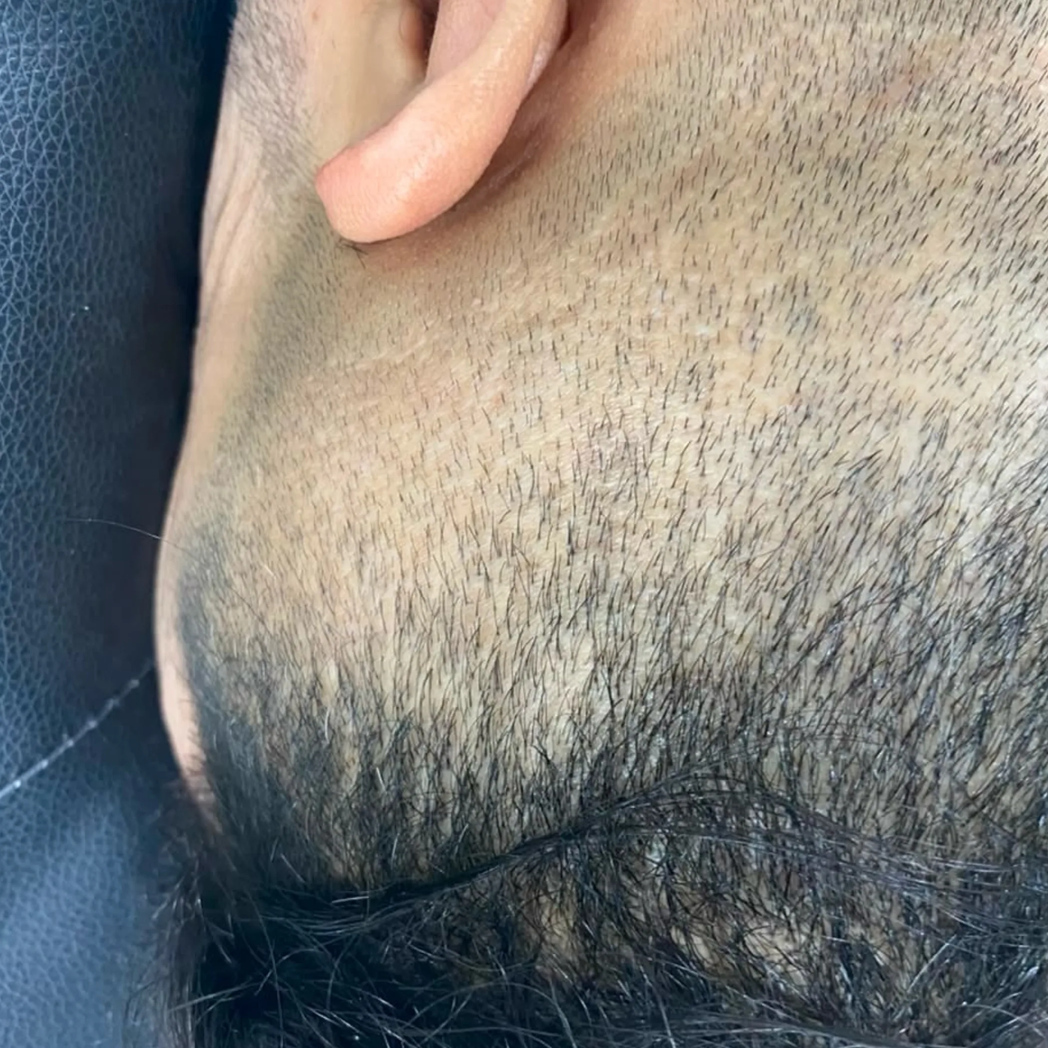 shaved scalp for micropigmentation