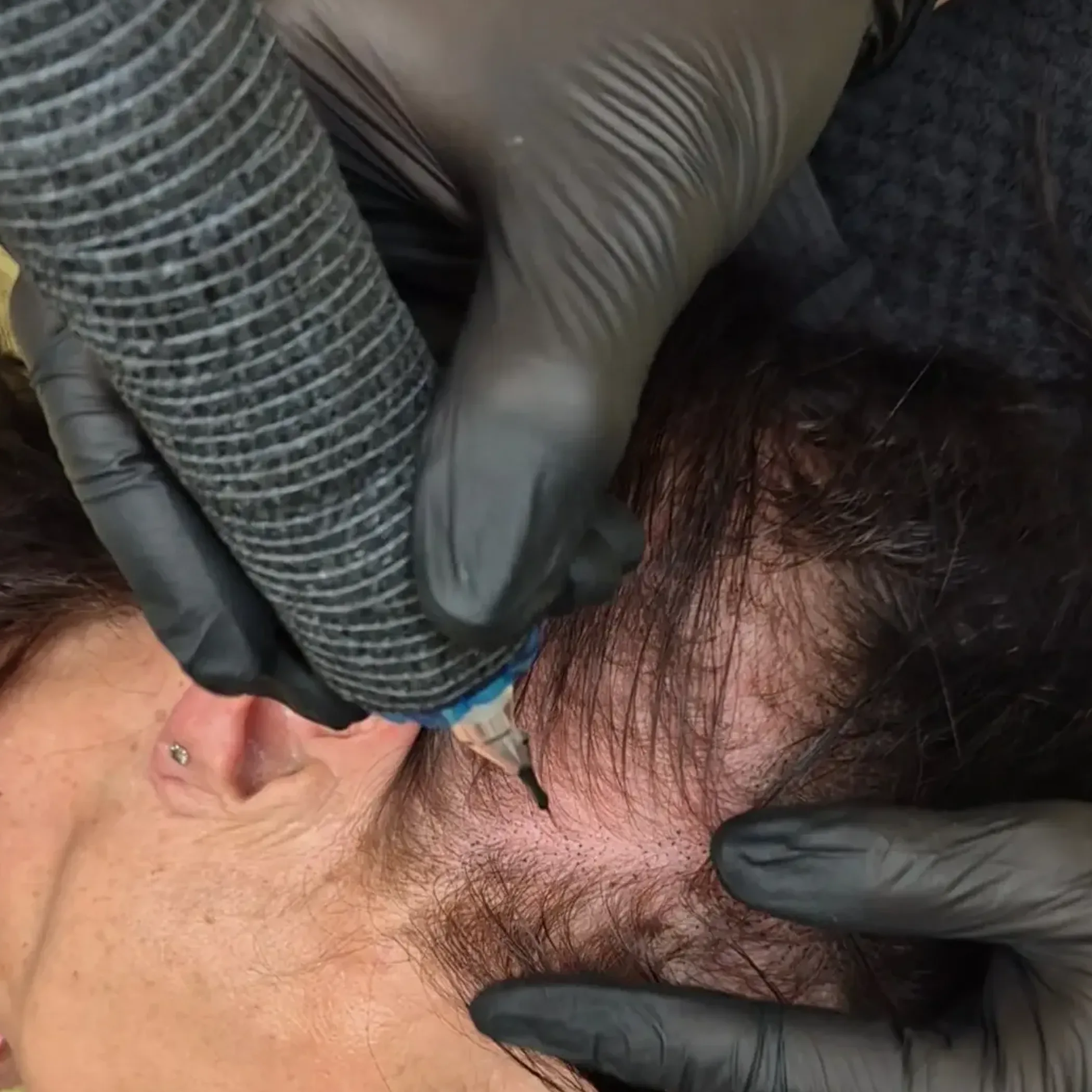 scalp micropigmentation treatment